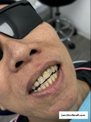 Close-up of a person's mouth with dental protection, showing teeth.