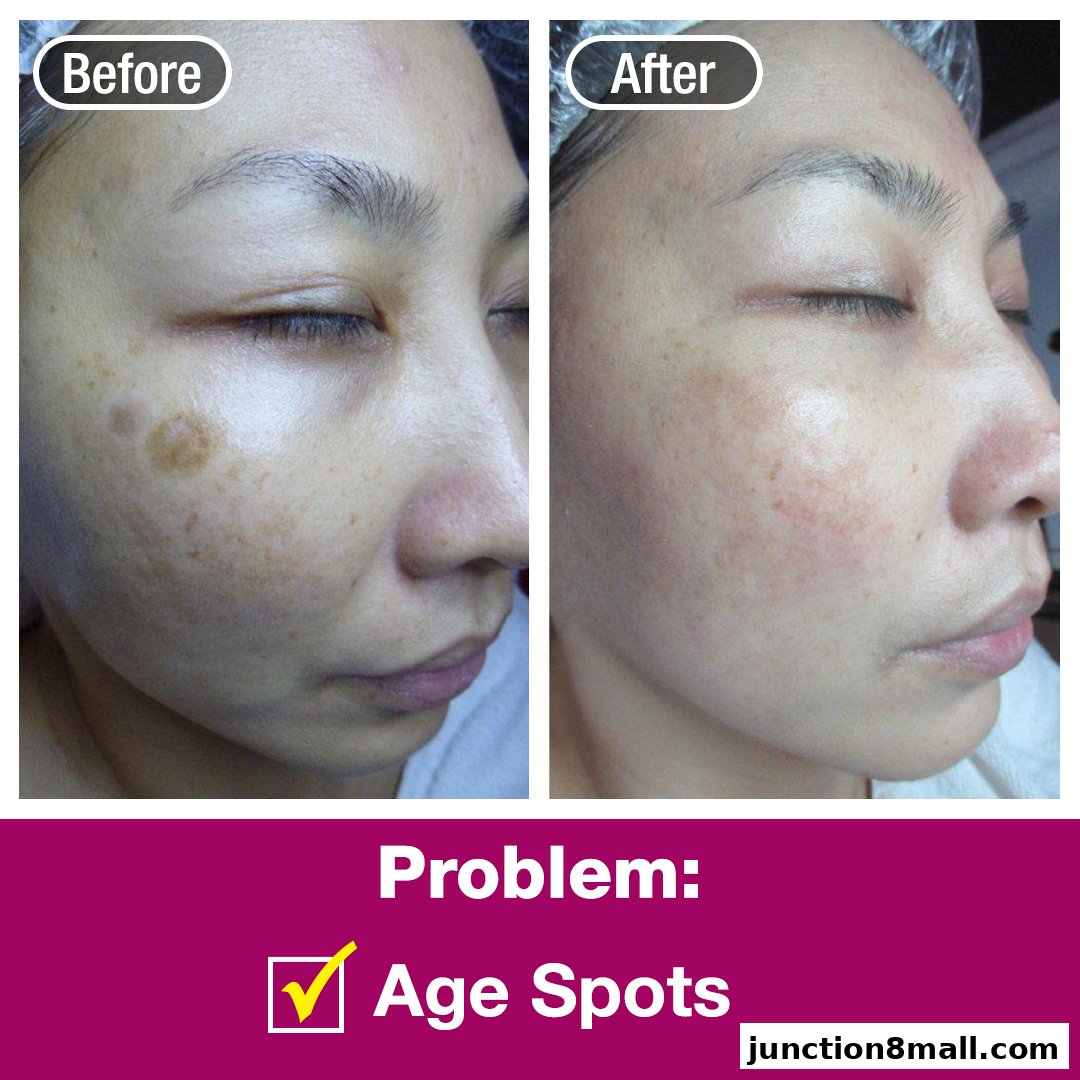 Before and after images showing a woman's face with age spots treated.